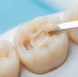 Application de résine composite sur une molaire