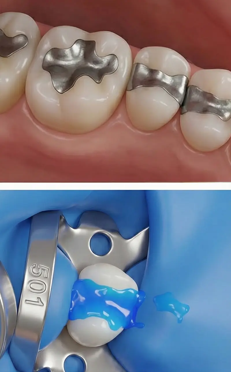 Protocole sécurisé de retrait d'un amalgame dentaire avec digue